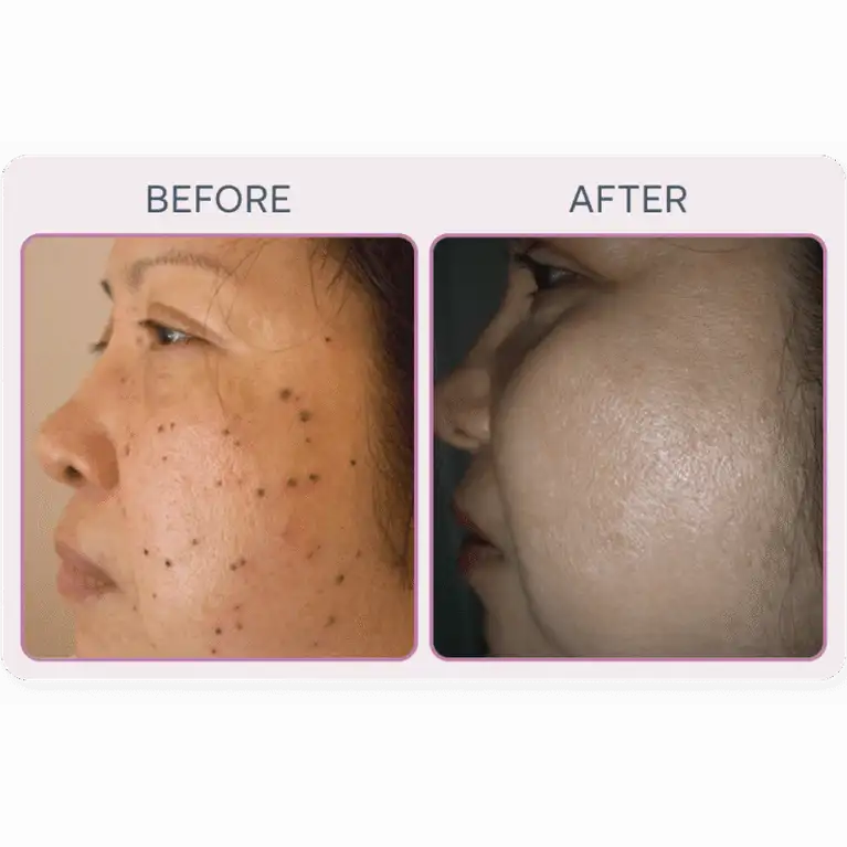 Martinni SuperFrecator Skincare Machine - 3rd Generation