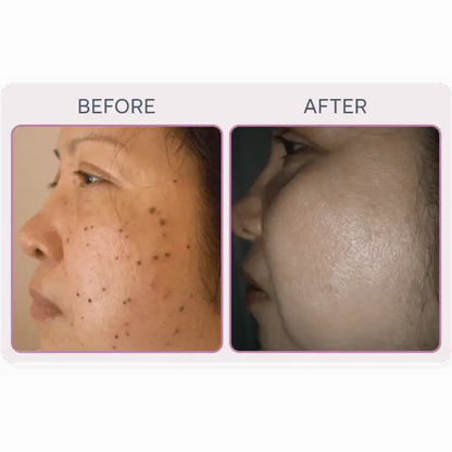 Martinni SuperFrecator Skincare Machine - 3rd Generation