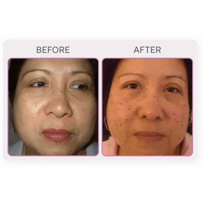 Martinni SuperFrecator Skincare Machine - 3rd Generation