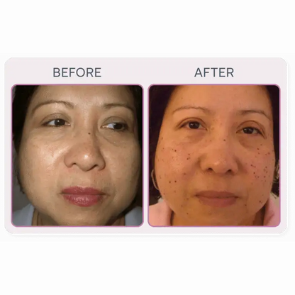 Martinni SuperFrecator Skincare Machine - 3rd Generation