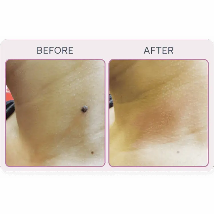 Martinni SuperFrecator Skincare Machine - 3rd Generation