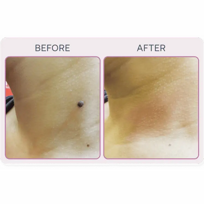 Martinni SuperFrecator Skincare Machine - 3rd Generation