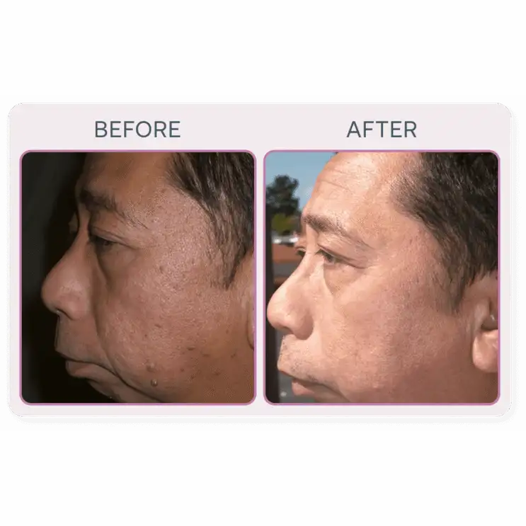 Martinni SuperFrecator Skincare Machine - 3rd Generation