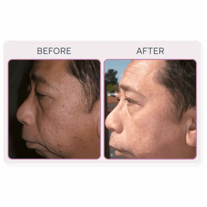 Martinni SuperFrecator Skincare Machine - 3rd Generation