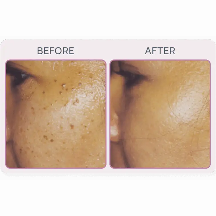 Martinni SuperFrecator Skincare Machine - 3rd Generation