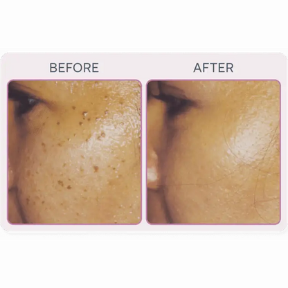 Martinni SuperFrecator Skincare Machine - 3rd Generation
